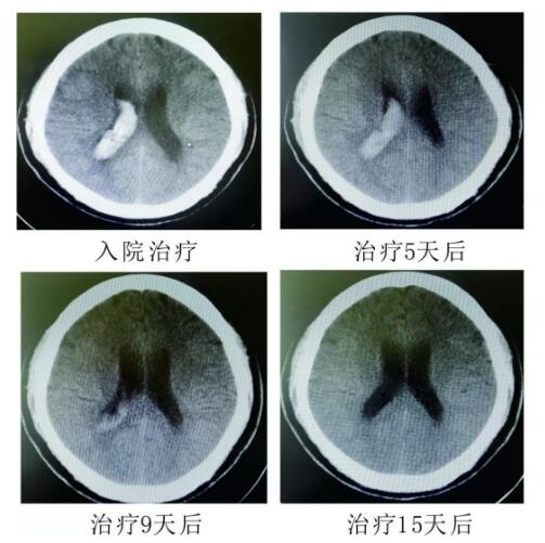 腦出血你不得不引起重視的疾?。。?！