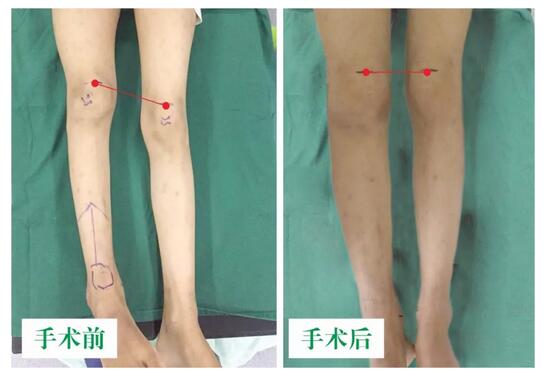 女孩墜梯右腿縮短5cm，幸得醫(yī)生及時診治恢復正常腿型