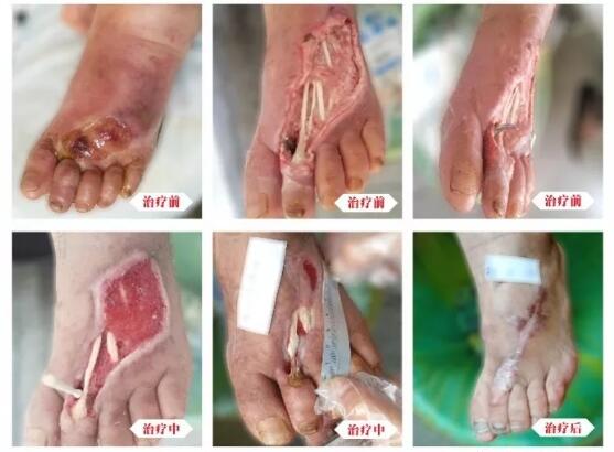 糖尿病并發(fā)癥有多可怕，及時(shí)治療糖尿病足避免截肢！