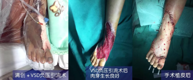 車禍猛如虎，救治如“華佗” ，手術(shù)＋康復，8歲小女孩車禍后日漸康復行走