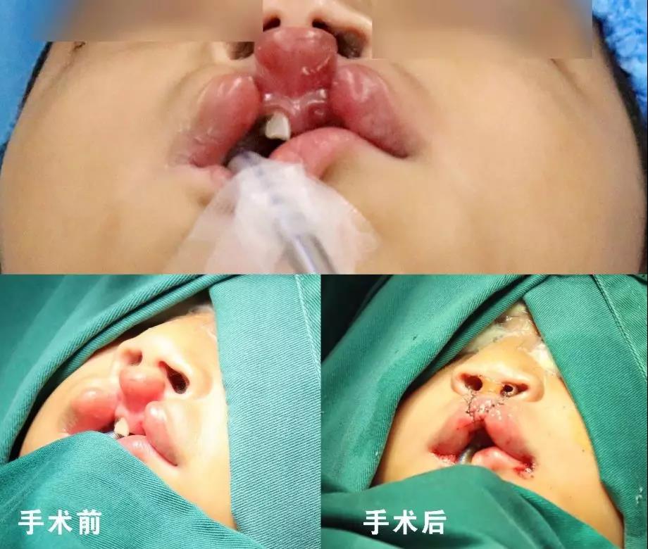 唇腭裂盡早治療消除孩子自卑心理，快樂成長！
