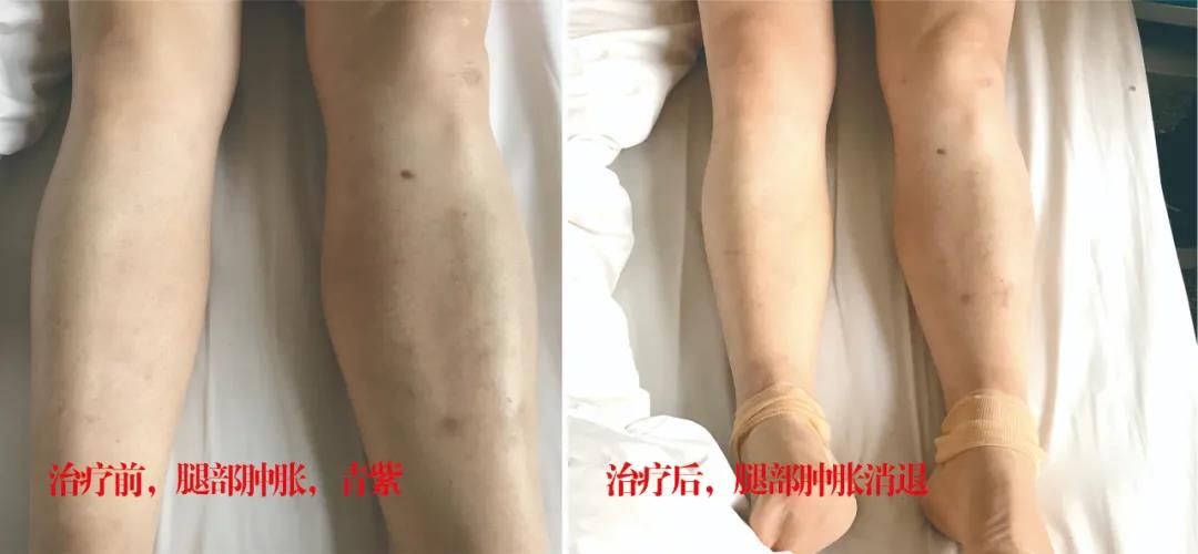 下肢靜脈血栓多年頑疾反復腫痛——疾病不容等待，早治療，早健康！