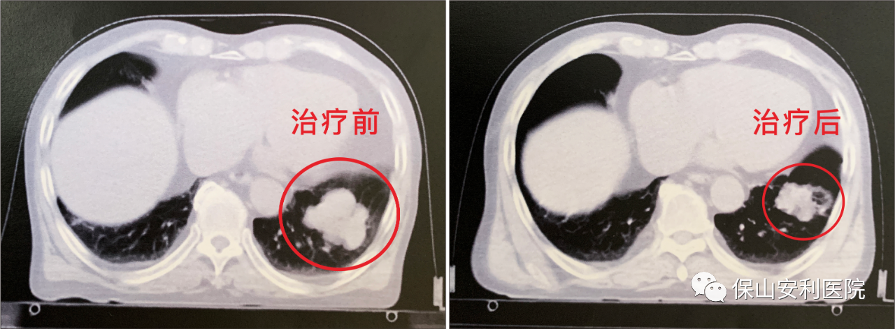 不做手術(shù)，早期肺癌也能根治！