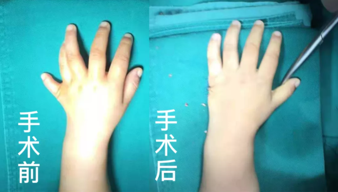 【保山安利醫(yī)院】2歲小兒手、足多指（趾）成功修復(fù)(矯正）！