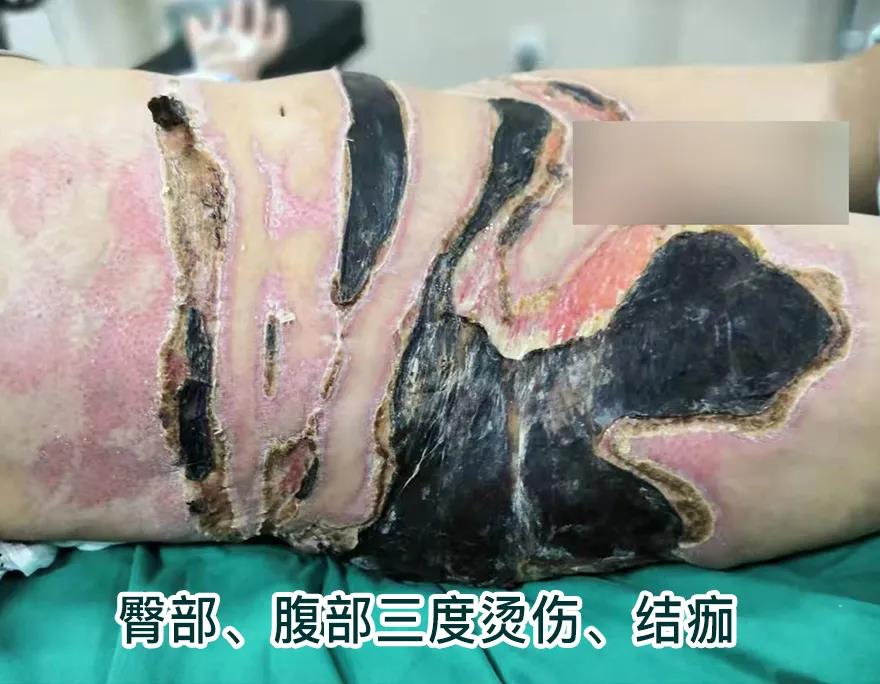 【保山安利醫(yī)院】80歲老人不慎燒傷，導(dǎo)致腹部、右側(cè)臀部大面積創(chuàng)傷，經(jīng)植皮治療創(chuàng)面逐漸愈合