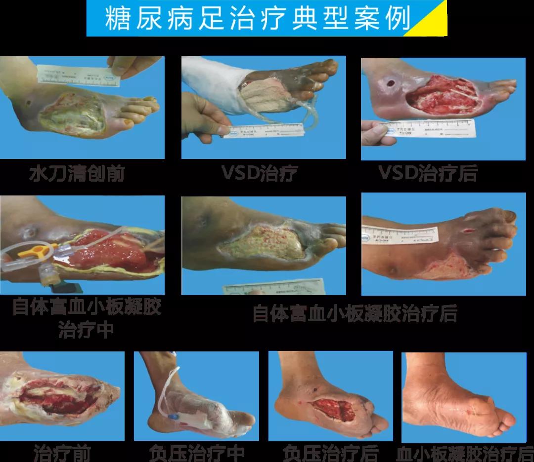 截肢、失明，甚至……，我們要做的是將糖尿病并發(fā)癥遏制在搖籃里！