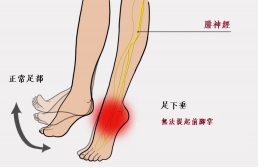 【保山安利醫(yī)院—健康科普】什么是足下垂！你了解嗎？