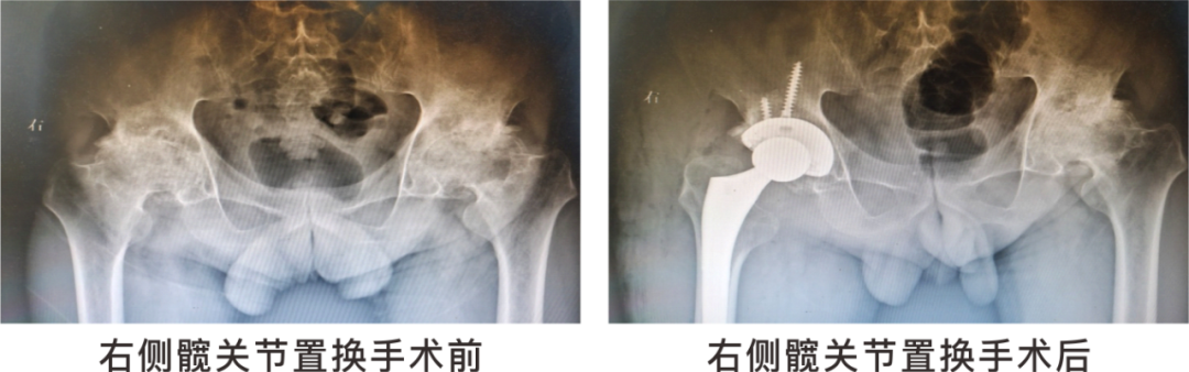 【保山安利醫(yī)院】長(zhǎng)期飲酒導(dǎo)致雙側(cè)股骨頭壞死，髖關(guān)節(jié)置換后重獲運(yùn)動(dòng)功能！