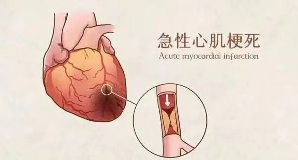 【保山安利醫(yī)院】11月20日“心梗救治日” 時間就是心肌，時間就是生命！